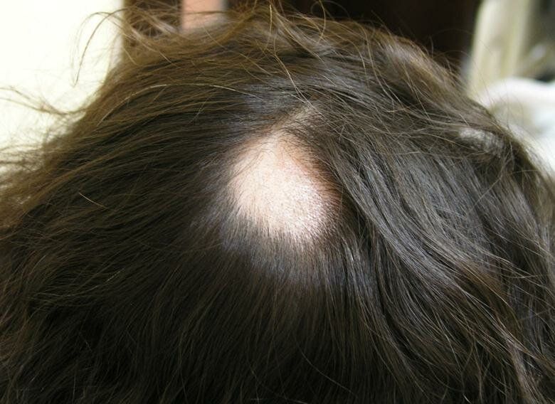Норма выпадения волос: сколько волос выпадает в день у женщин и мужчин?