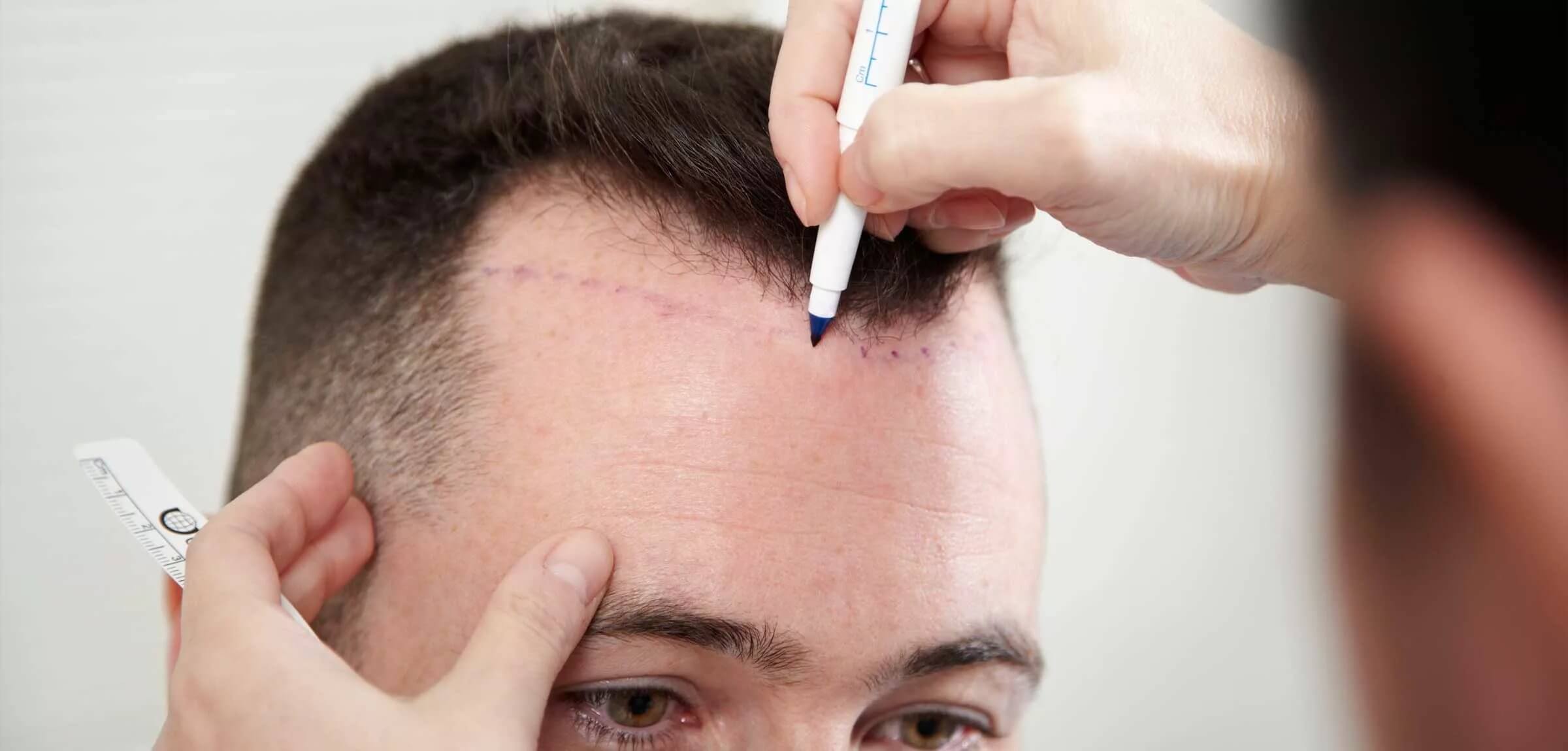 Этапы подготовки к процедуре трансплантации волос