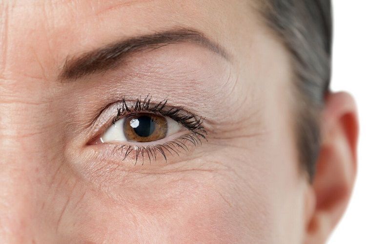 Лечение мимических морщин вокруг глаз