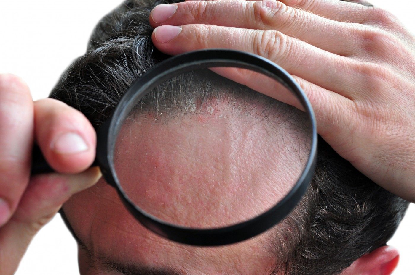 Заболевания кожи и волосистой части головы (Микроспория), Горноуральская районная поликлиника