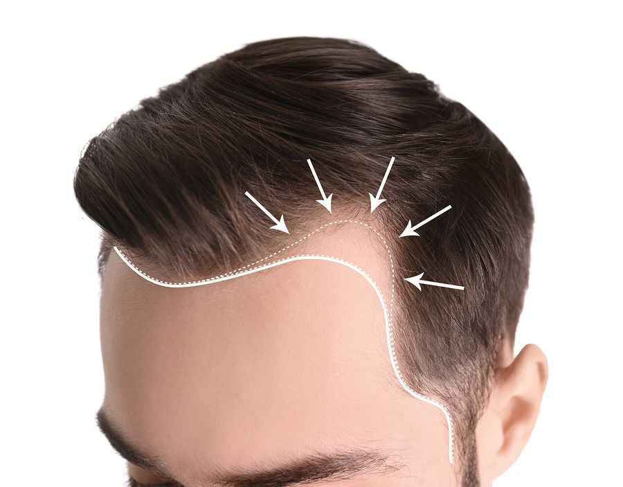 Как выстраиваются линии роста волос для пересадки