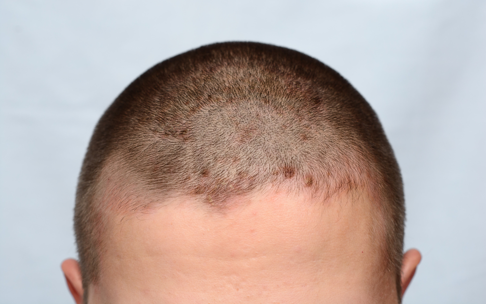 Стрептодермия волосистой части головы