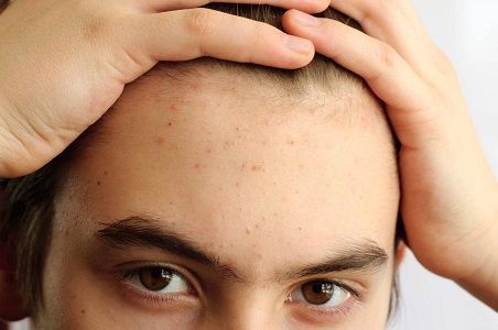 Угревая сыпь на лице: причины и лечение