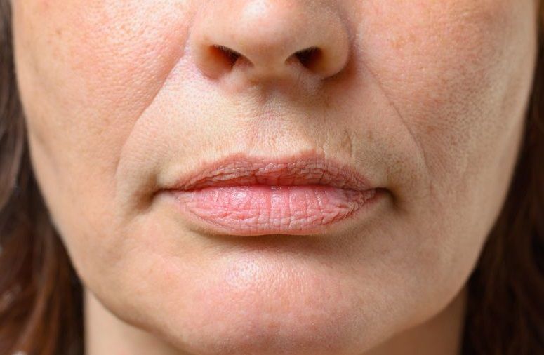 Как лечить морщины вокруг губ