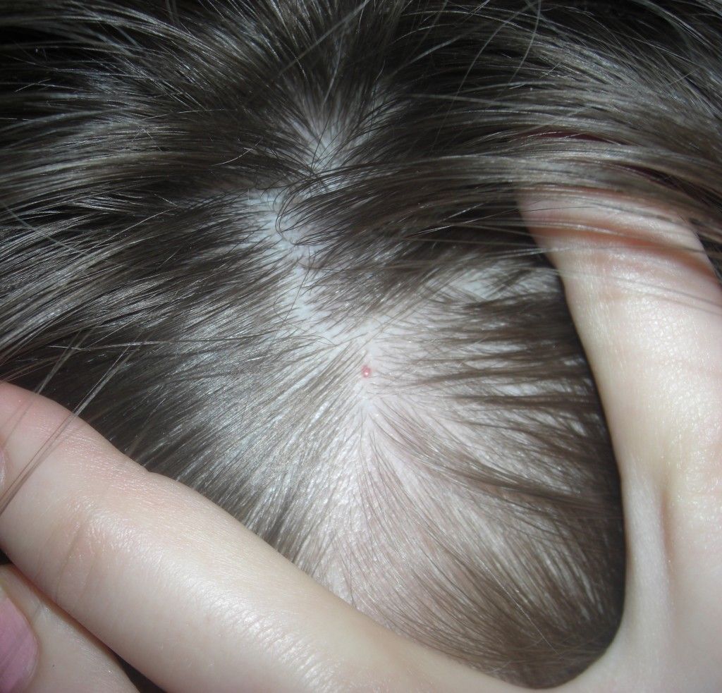 Прыщи на коже головы в волосах: причины и лечение