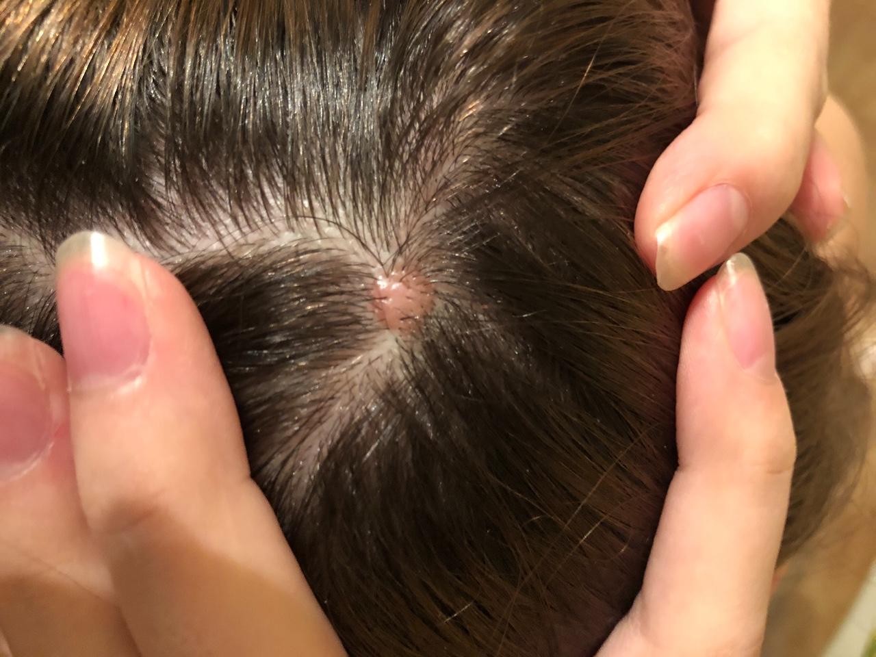 Прыщи на голове в волосах: причины и лечение