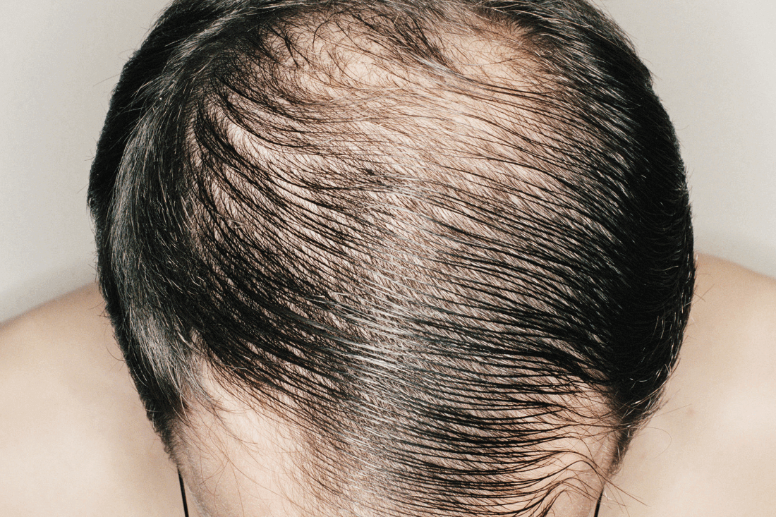Могут ли выпадать волосы из за нехватки железа в организме женщины