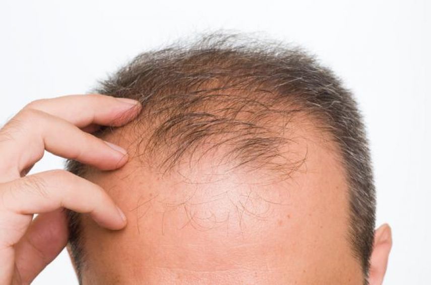 Виды терапии при выпадении волос