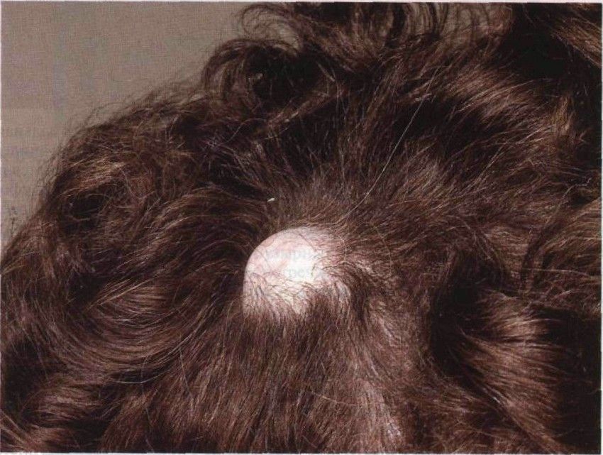 Фурункулез волосистой части головы