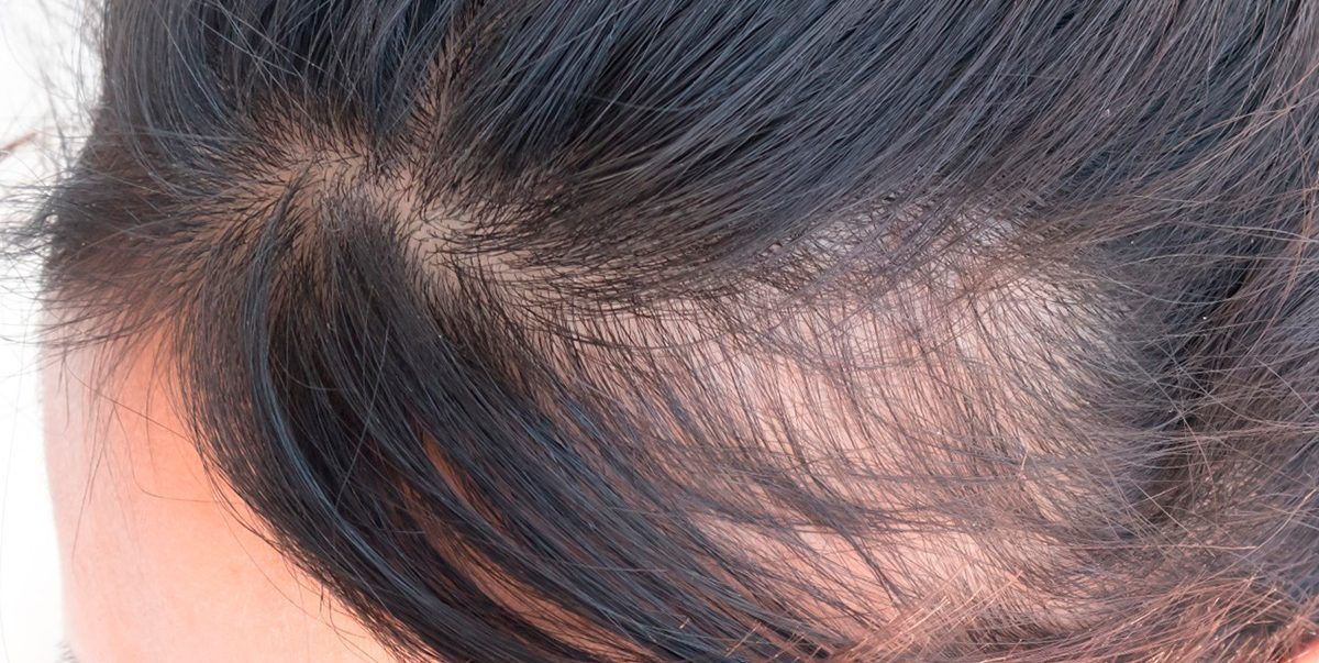 Прогестерон и выпадение волос