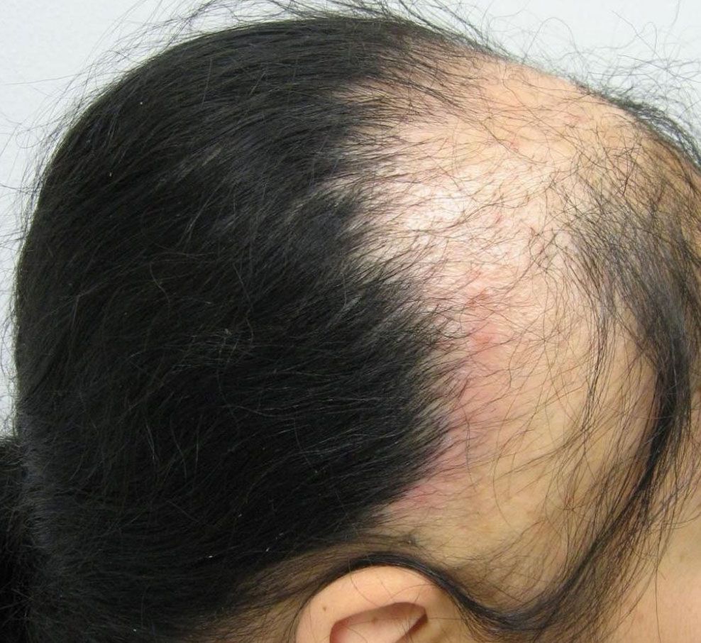 Диффузное выпадение волос